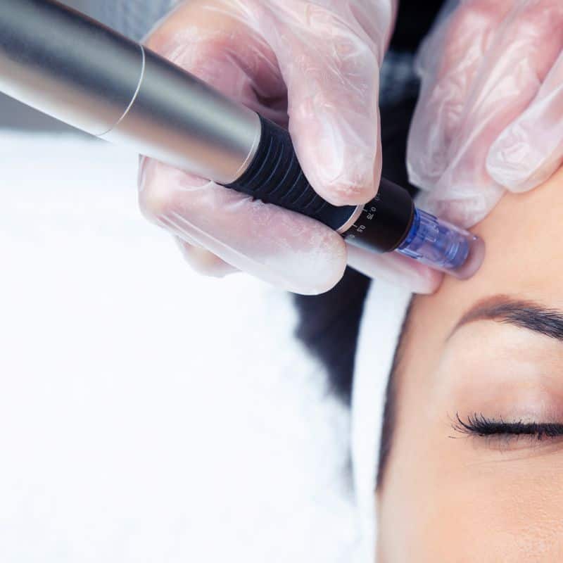 Morpheus8 treatment Thurrock Park from Lipo Sculpt - Book in today!
